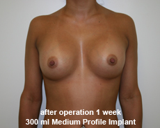 plastic-surgery-breast-augmentation